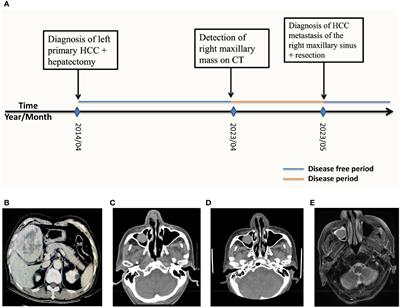 Case report and literature analysis: solitary HCC- recurrence in the right maxillary sinus after curative resection